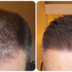 Key Changes to Expect When Starting Minoxidil Treatment for Thinning Hair