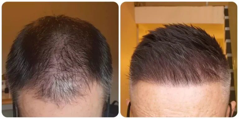 Key Changes to Expect When Starting Minoxidil Treatment for Thinning Hair